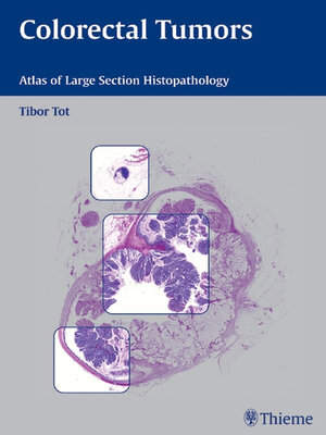 cover image of Colorectal Tumors
